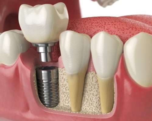 Tooth replacement with dental implants