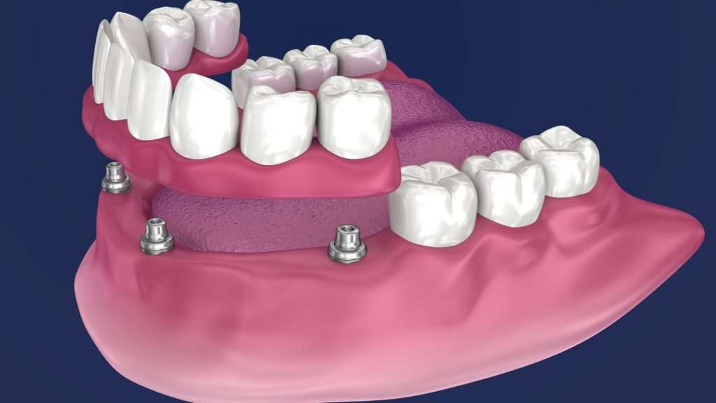 A 3d image of dental implants.